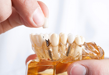 Sản phẩm răng sứ DFR